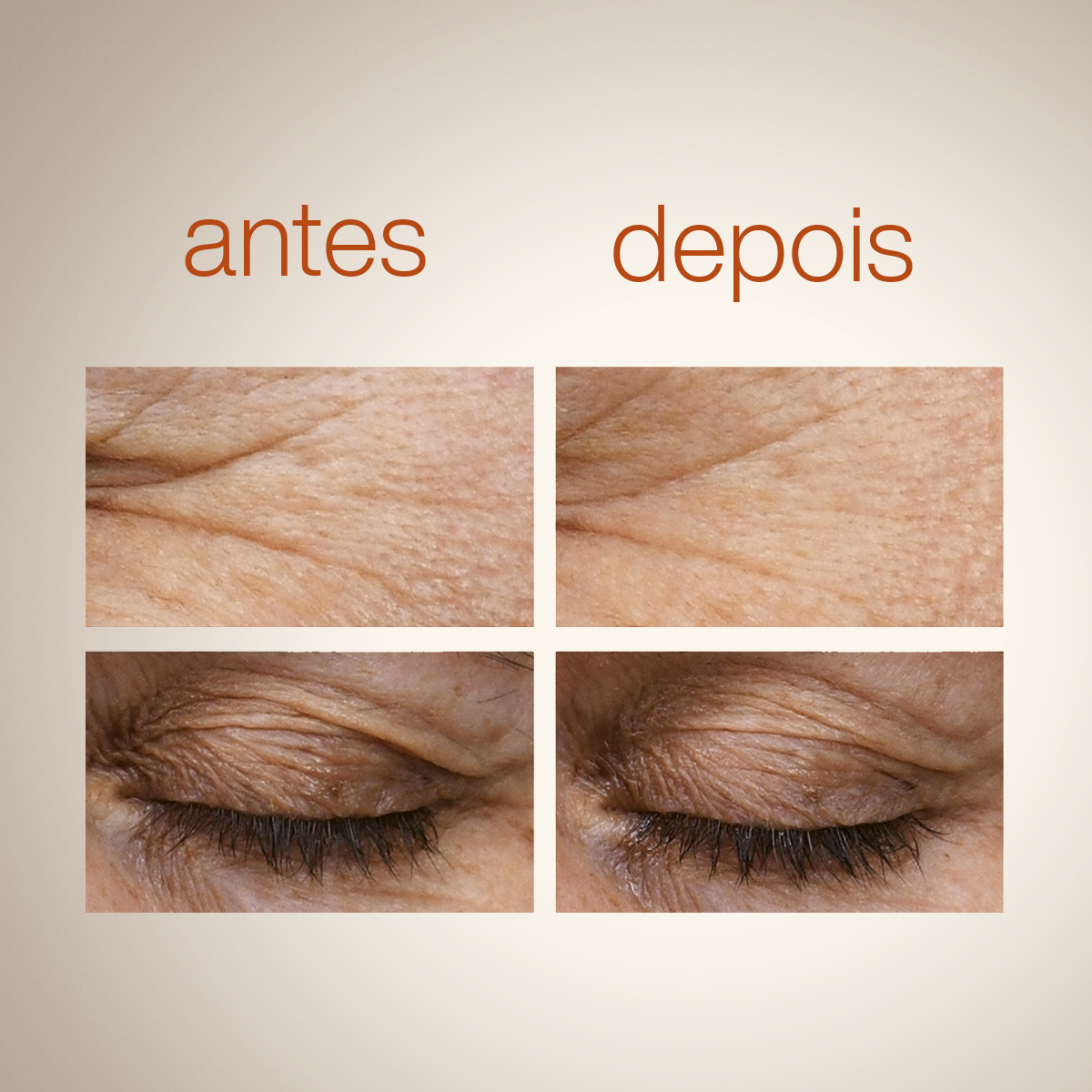 Super Sérum para Olhos Redutor de Rugas e Flacidez Chronos Derma